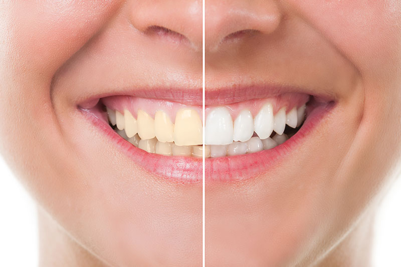 Teeth Whitening in Woodland Hills